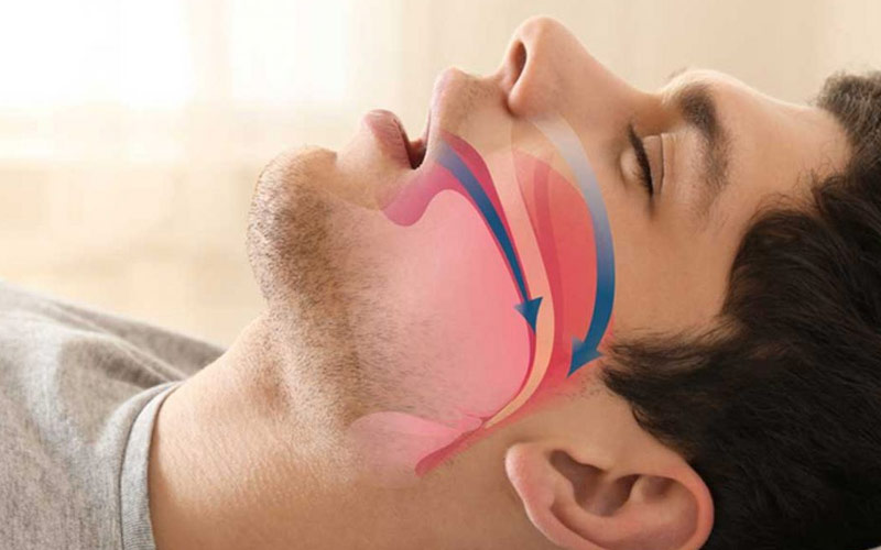 Uyku Apnesi Nasıl Geçer?