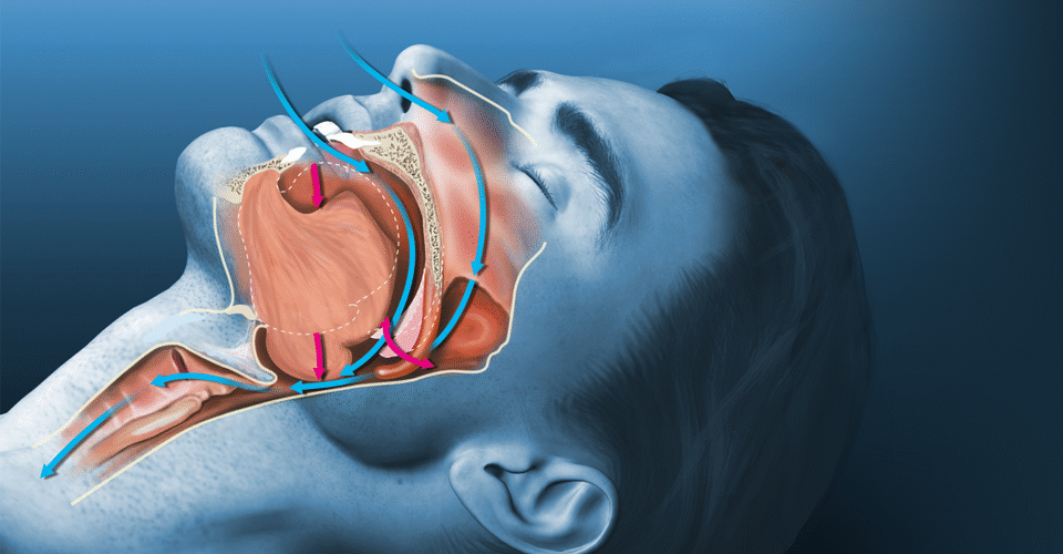 Uyku Apnesi Cpap Cihazı Samsun